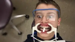 I GOT BRACES?!