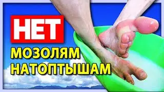 Убираем НАТОПТЫШИ и МОЗОЛИ за 10 минут. РАБОТАЮЩИЙ СПОСОБ👍