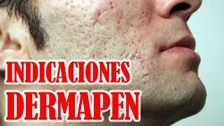 🟢 CLASE TEORICA DERMAPEN 👨‍⚕ : En que casos lo indicamos? TIPOS de CICATRICES DE ACNE, ANTIAGE
