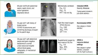 Management of ARDS By Dr.Anand Nikalje