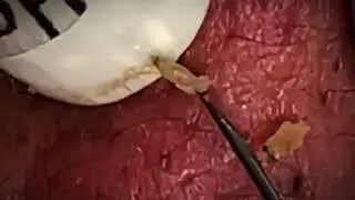 Very Satisfying Blackheads Remove 2024