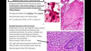 Lung Adenocarcinoma, Squamous Cell Carcinoma, and Neuroendocrine Tumors: Kurt's Notes 