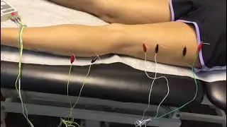 Dry Needling for lumbar radiculopathy and low back pain.