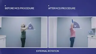 Most Effective Frozen Shoulder Treatment! Frozen Shoulder Cured in One Visit!