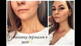 Устанавливаем микродермалы в шею, ОПЯТЬ