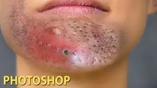 Chin Blackheads! Comedone Extractor Tools