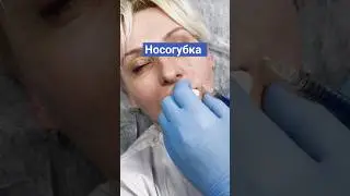 Что делать с носогубной складкой?