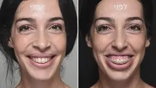 חיוך חושף חניכיים - מרכז כירורגי שוורץ-ארד