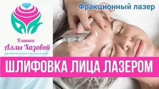 Фракционный лазер СО2. Лазерная шлифовка в Москве. Процедура лазерной шлифовки. Углекислотный лазер.