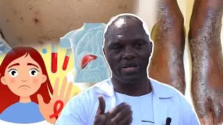 Dore indwara yandura nka SIDA, ingamba zarafashwe kandi yo iravurwa igakira. Gukoresha agakingirizo
