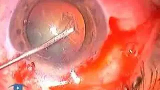Corneal Distortion & Striae Phaco 3.1 Complications