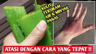 Skin Scalded With Hot Water Or Hot Oil, Immediately Apply With These Natural Ingredients