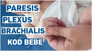 Paresis Plexus Brachialis Kod Bebe