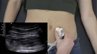 Abdomensonografie - Iliakalgefäße
