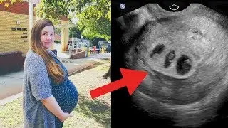 22-Jährige ist schwanger - was sie am Ultraschall sieht, ist zugleich schön und beängstigend!