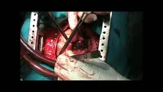 Excision of Giant Right Atrial Myxoma on Beating Heart