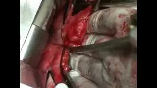 Операция на Открытом Сердце. Извлечение Паразитов.