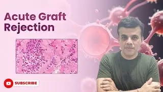 The Unseen Threat Of Acute Graft Rejection-Explained I