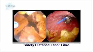Safety Distance Laser Fiber