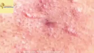 BIG Blackheads Removal   Acne Treatment   SPA ASMG   Blackheads on face #172