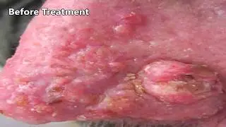 Killa Blackheads! Case Study