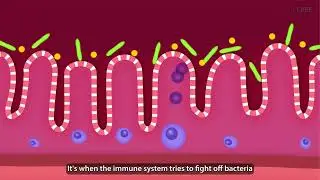 Ulcerative Colitis 101 | GUTCARE