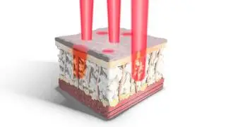 Fraxel Laser Animation - www.medinnova.ru