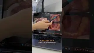 В этом видео нагляжно покажем,как происходит лечение неправильного прикуса с помощью брекет-системы