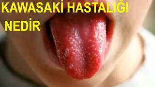 Kawasaki Hastalığı -  Koronavirüsten Sonra