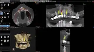 Viršutinio žandikaulio dantų implantacija klinikoje "Papadent"