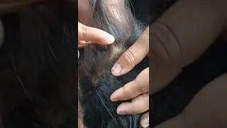 Louse Removal From Hair