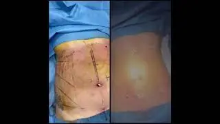 Liposuzione ultrasonica ad alta definizione 4d - foto pre e post
