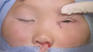Surgery: External DCR with Canalicular Repair