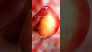 Finger Felon Fix: Infection Drainage (3D Animation)