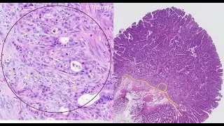 Implementation guidance for reporting of colorectal cancer
