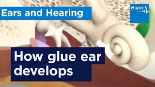 How glue ear develops | Bupa Health