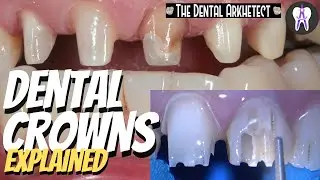 DENTAL CROWNS! Patient's Request to Make Her Teeth Uniform 
