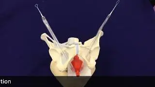 InGyne S istructions for removall the sheath   new version 2018                     cod  IGSD1250EL