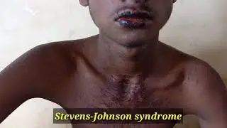 Stevens-Johnsons syndrome. muco-cuteneus manifestation.