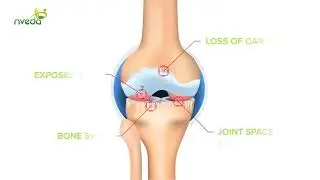 Nveda Joint Support for Knee & joint Pain