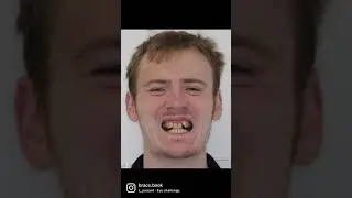 Before and after braces with @brace.book 