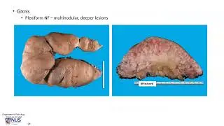 Skin - Neurofibroma (Gross pathology)
