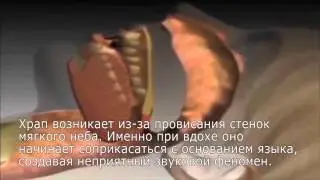 Как избавиться от храпа беременной - смотрите и убедитесь