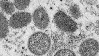 What to know about the monkey pox outbreak