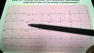 Previous Myocardial Infarction EKG ECG Uri Ben Zur MD