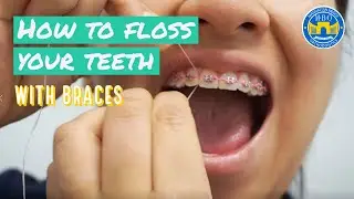 How to Floss with Braces? - 3 Flossing Tips