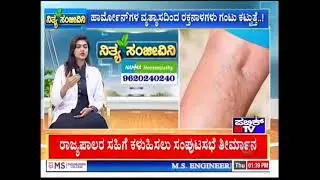 Namma Homeopathy Dr Annapurna Varicose veins