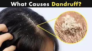 What is Dandruff? | Causes And Treatment (Urdu/Hindi)