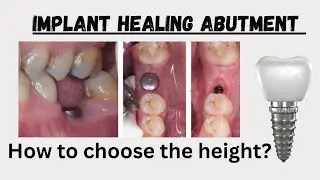 How to choose the height of Healing Abutment/ Gingival former after Dental Implant placement?