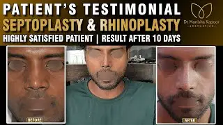 Breathing Issue Solved | Corrected Deviated Septum | Rhinoplasty Before & After | Dr. Monisha Kapoor